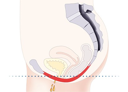 Pelvic-Floor Muscle Repair 5 Pelvic floor muscles Bracknell