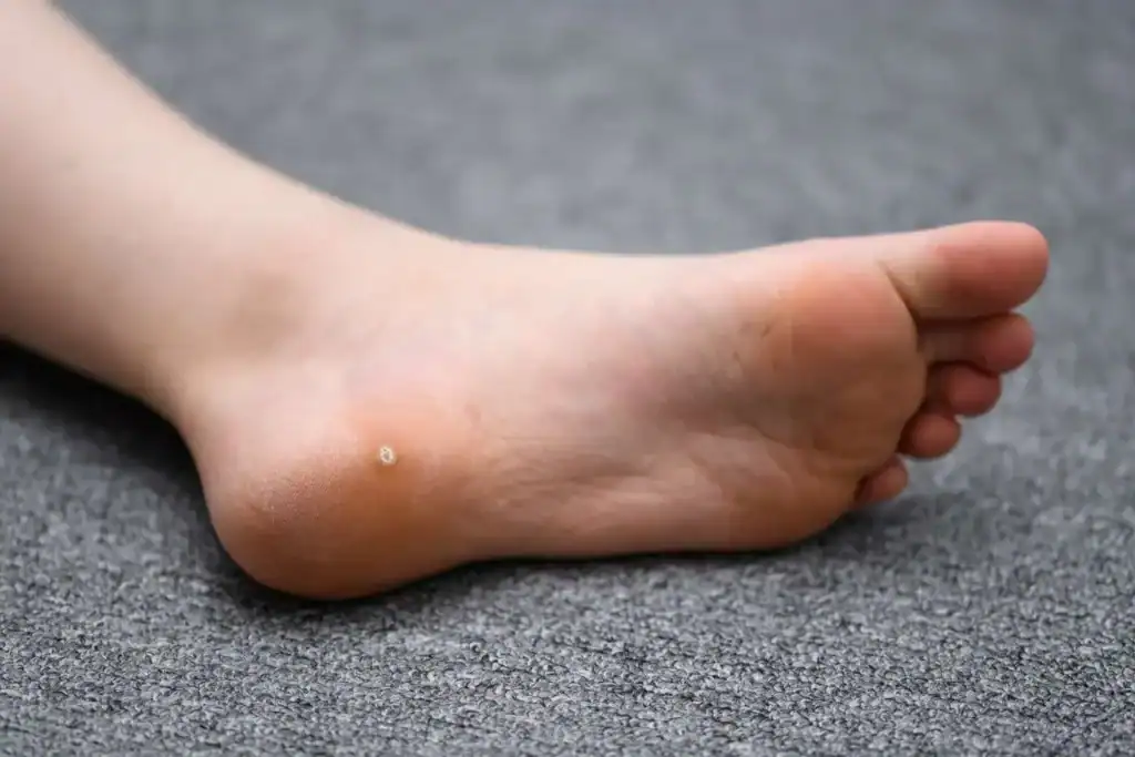 Cryotherapy For Warts And Also Verrucas 2 Image of verruca on the bottom of the foot that able to be treated with Cryotherapy Bracknell