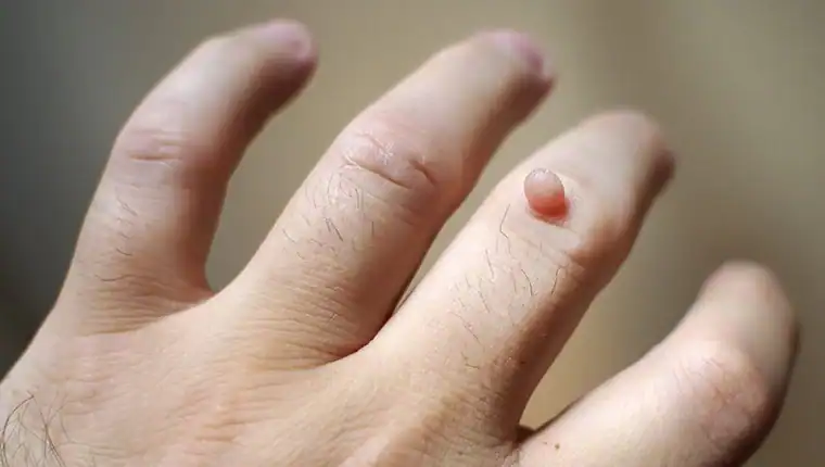 Image of blemish that Cryotherapy Bracknell 	 can remove with Lipo 360.