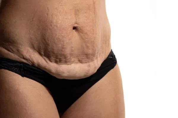 The science behind skin tightening Bracknell 	 picture of a woman's sagging skin on the stomach